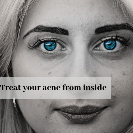 TREAT ACNE FROM INSIDE